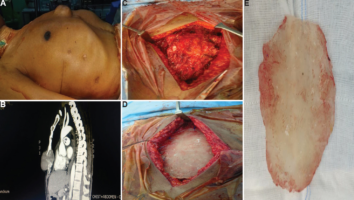 (A) The patient with sternal chondrosarcoma presented with large swelling in front of chest (red arrow). (B) Preoperative computed tomographic angiogram showing globular tumour at lower end of sternum (yellow arrow). (C) Intraoperative photograph showing sternum detached all around from the chest wall at costochondral junction. (D) Intraoperative photograph showing artificial sternum attached to the chest wall by sutures. (E) Polymethyl methacrylate handmade model made into shape of sternum before implanting to the patient.